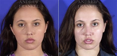 buccal fat removal los angeles